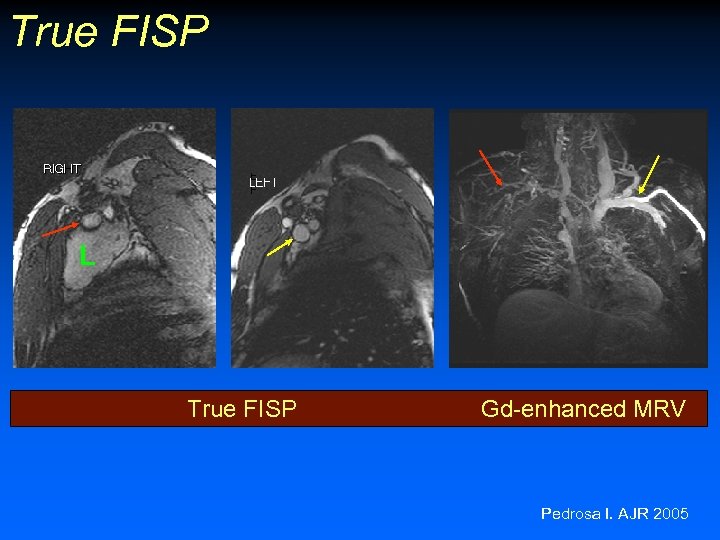 True FISP L True FISP Gd-enhanced MRV Pedrosa I. AJR 2005 