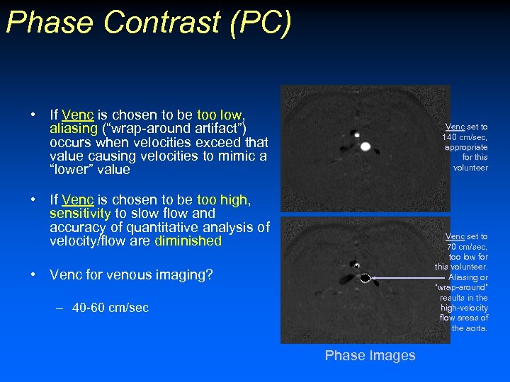 Phase Contrast (PC) • If Venc is chosen to be too low, aliasing (“wrap-around