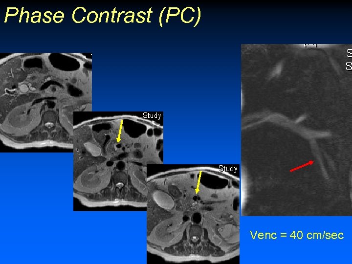 Phase Contrast (PC) Venc = 40 cm/sec 