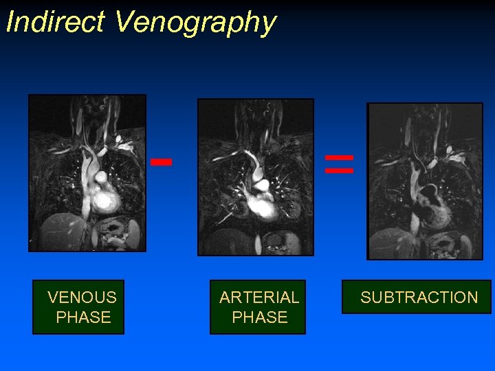 Indirect Venography VENOUS PHASE = ARTERIAL PHASE SUBTRACTION 