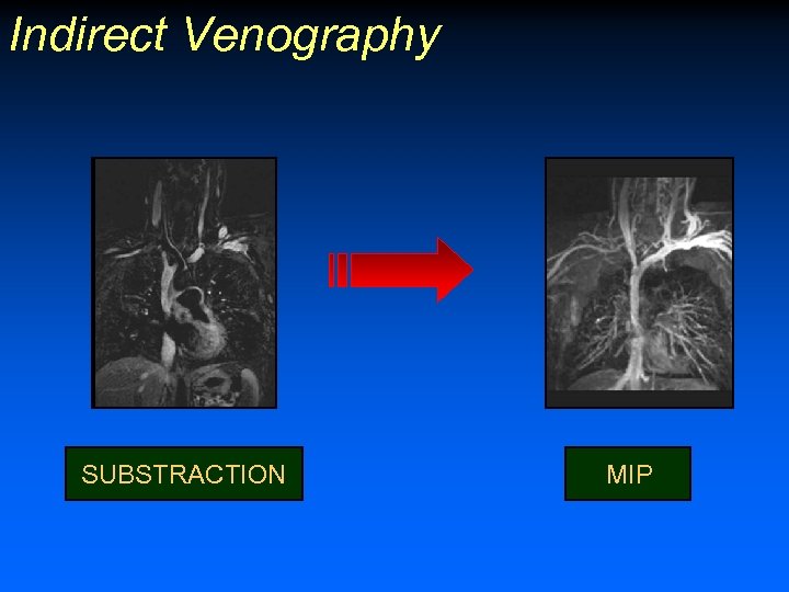 Indirect Venography SUBSTRACTION MIP 