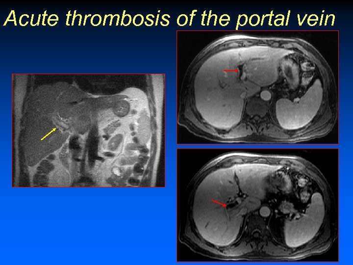 Acute thrombosis of the portal vein 