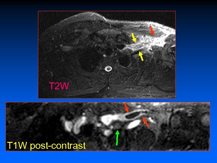 T 2 W T 1 W post-contrast 