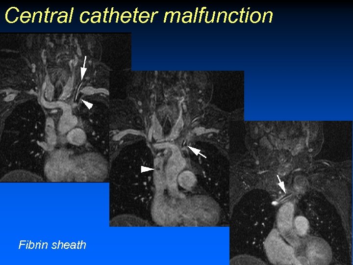 Central catheter malfunction Fibrin sheath 