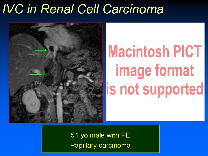 IVC in Renal Cell Carcinoma 51 yo male with PE Papillary carcinoma 