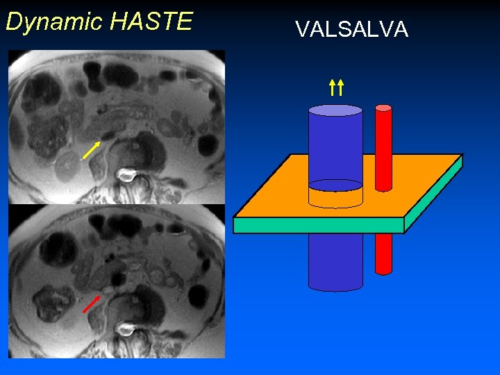 Dynamic HASTE • Valsalva – intrathoracic P – Venous return • T 2 of