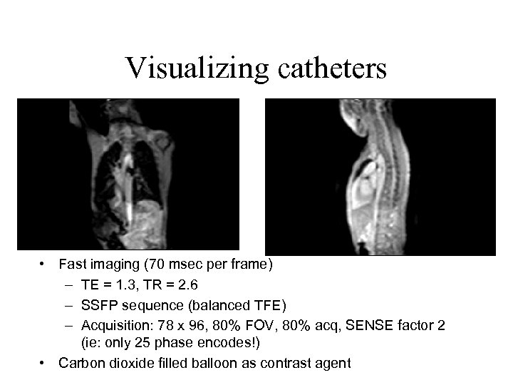 Visualizing catheters • Fast imaging (70 msec per frame) – TE = 1. 3,