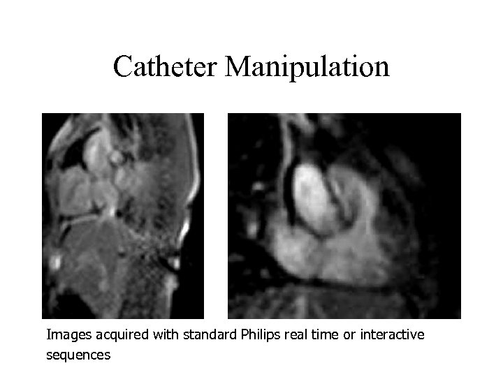 Catheter Manipulation Images acquired with standard Philips real time or interactive sequences 