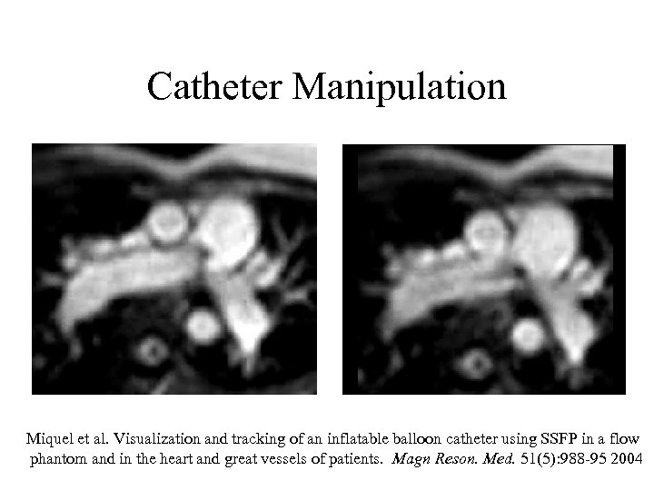 Catheter Manipulation Miquel et al. Visualization and tracking of an inflatable balloon catheter using