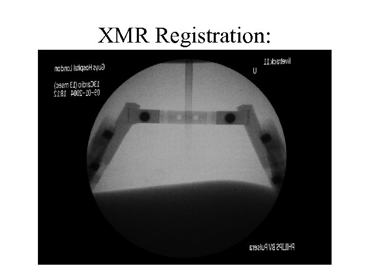 XMR Registration: MR Overlay on X-Ray 