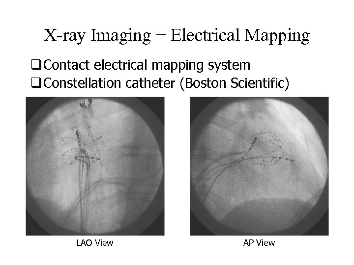 X-ray Imaging + Electrical Mapping q Contact electrical mapping system q Constellation catheter (Boston