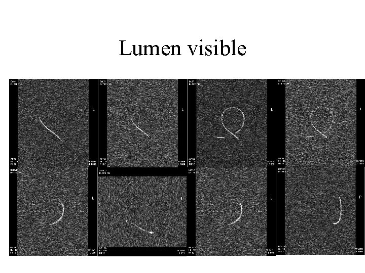 Lumen visible 