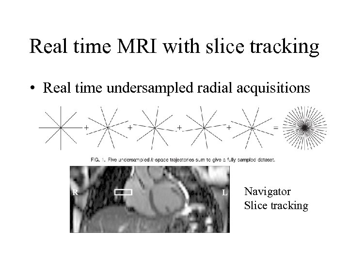 Real time MRI with slice tracking • Real time undersampled radial acquisitions Navigator Slice