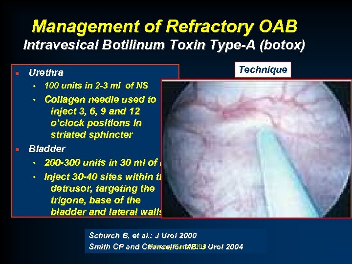 Management of Refractory OAB Intravesical Botilinum Toxin Type-A (botox) · Technique Urethra • 100