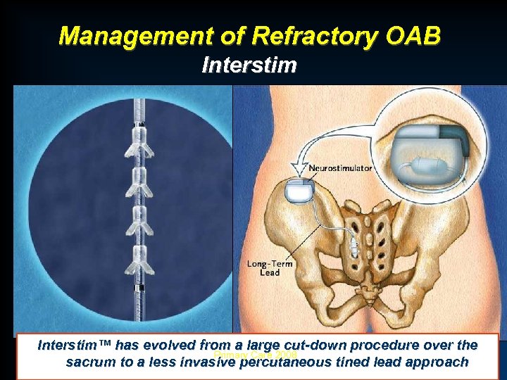 Management of Refractory OAB Interstim™ has evolved from a large cut-down procedure over the