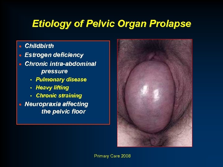 Etiology of Pelvic Organ Prolapse Childbirth · Estrogen deficiency · Chronic intra-abdominal pressure ·