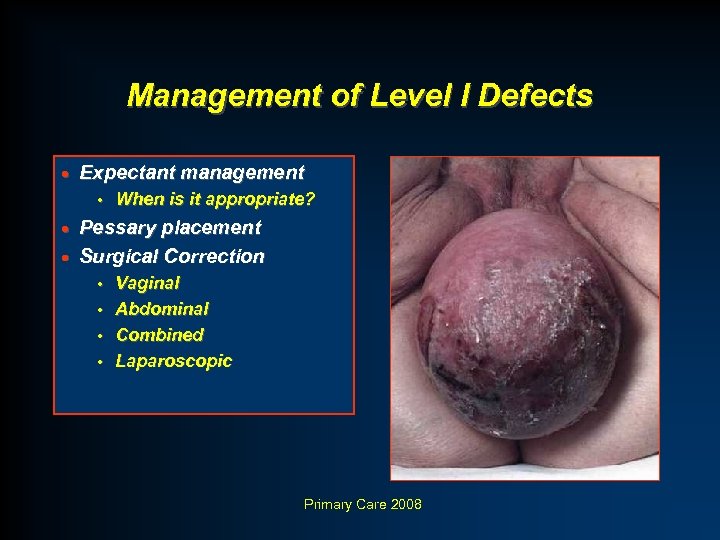 Management of Level I Defects · Expectant management • When is it appropriate? Pessary