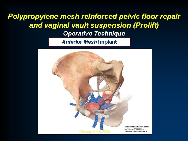 Polypropylene mesh reinforced pelvic floor repair and vaginal vault suspension (Prolift) Operative Technique Anterior