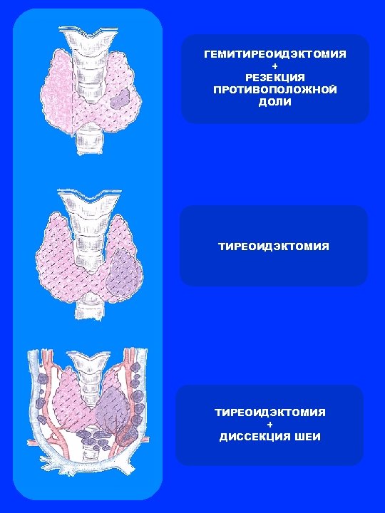 ГЕМИТИРЕОИДЭКТОМИЯ + РЕЗЕКЦИЯ ПРОТИВОПОЛОЖНОЙ ДОЛИ ТИРЕОИДЭКТОМИЯ + ДИССЕКЦИЯ ШЕИ 