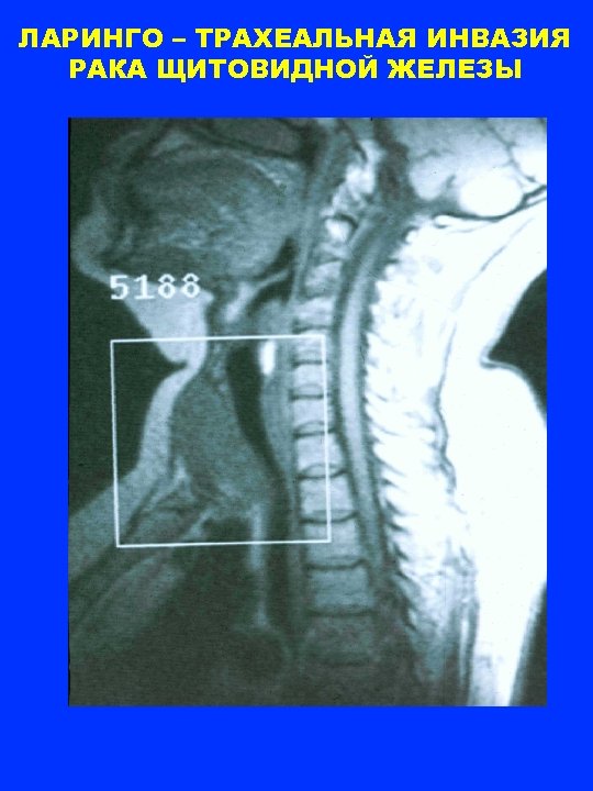 ЛАРИНГО – ТРАХЕАЛЬНАЯ ИНВАЗИЯ РАКА ЩИТОВИДНОЙ ЖЕЛЕЗЫ 
