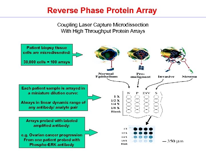 Reverse Phase Protein Array Coupling Laser Capture Microdissection With High Throughput Protein Arrays Patient