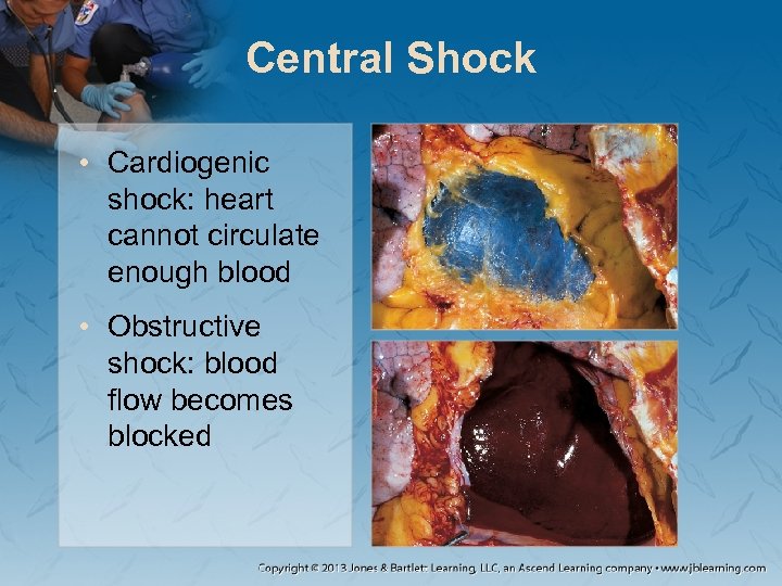Central Shock • Cardiogenic shock: heart cannot circulate enough blood • Obstructive shock: blood