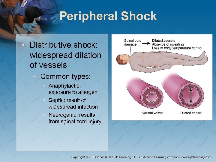 Peripheral Shock • Distributive shock: widespread dilation of vessels − Common types: • Anaphylactic: