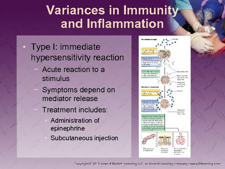 Variances in Immunity and Inflammation • Type I: immediate hypersensitivity reaction − Acute reaction