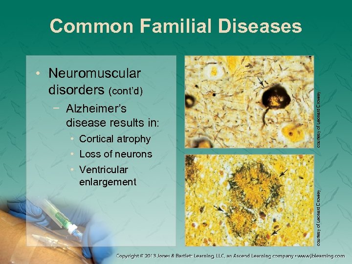 − Alzheimer’s disease results in: • Cortical atrophy • Loss of neurons • Ventricular