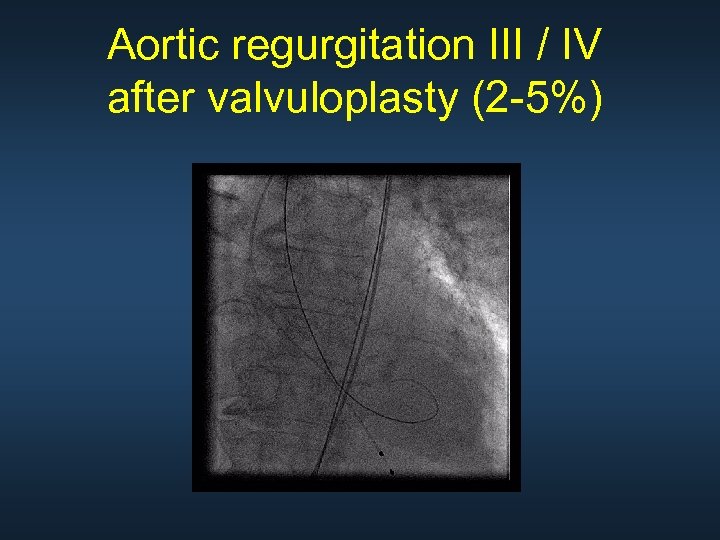 Aortic regurgitation III / IV after valvuloplasty (2 -5%) 