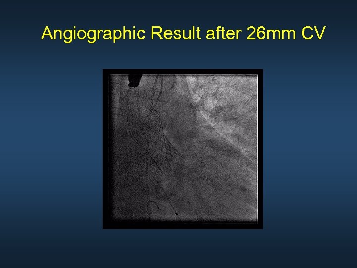 Angiographic Result after 26 mm CV 