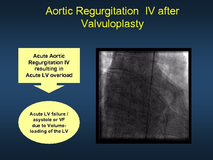 Aortic Regurgitation IV after Valvuloplasty Acute Aortic Regurgitation IV resulting in Acute LV overload