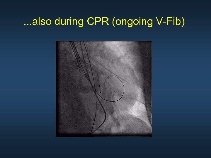 . . . also during CPR (ongoing V-Fib) 