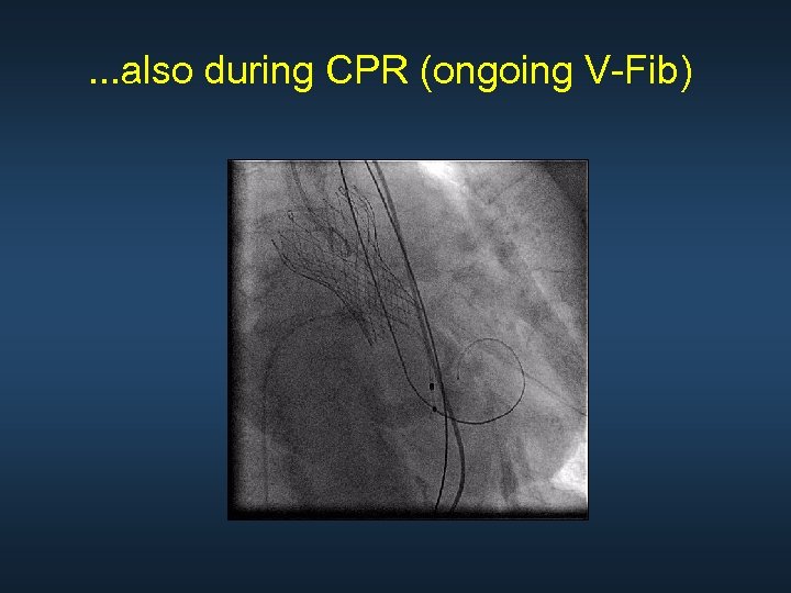 . . . also during CPR (ongoing V-Fib) 
