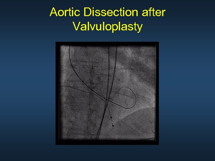 Aortic Dissection after Valvuloplasty 