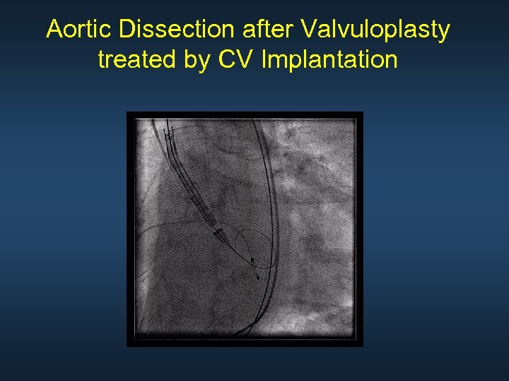 Aortic Dissection after Valvuloplasty treated by CV Implantation 