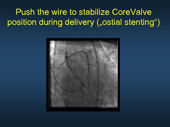 Push the wire to stabilize Core. Valve position during delivery („ostial stenting“) 
