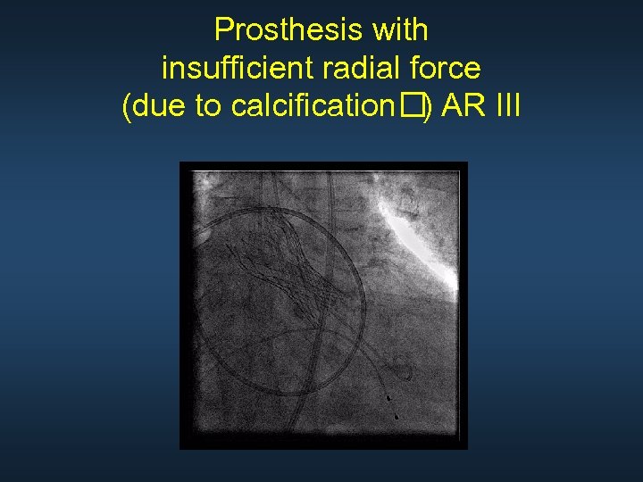 Prosthesis with insufficient radial force (due to calcification AR III ) 
