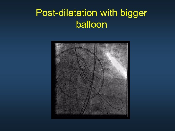 Post-dilatation with bigger balloon 