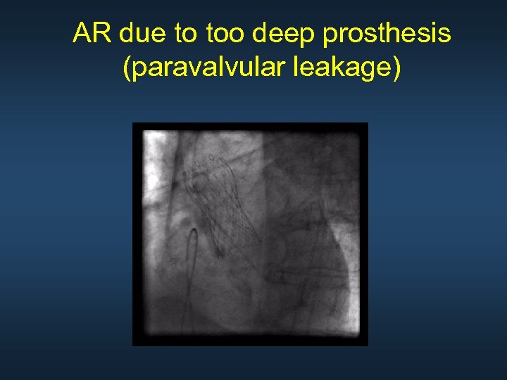 AR due to too deep prosthesis (paravalvular leakage) 