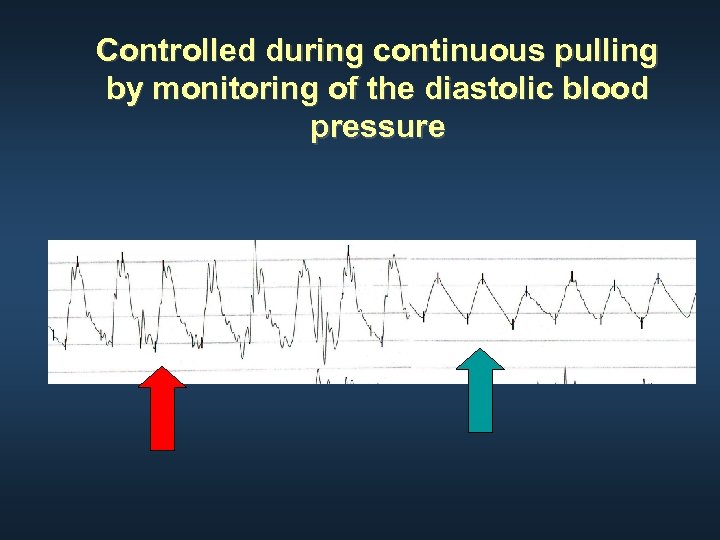 Controlled during continuous pulling by monitoring of the diastolic blood pressure 