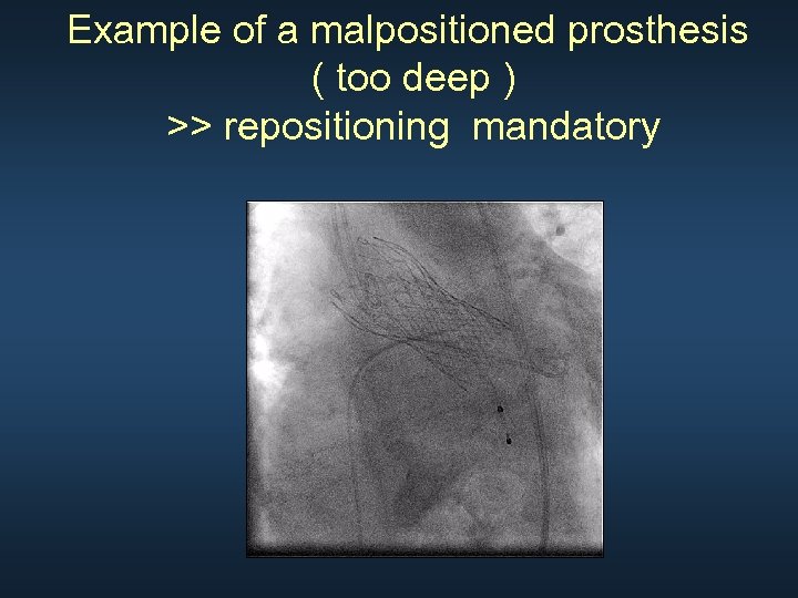 Example of a malpositioned prosthesis ( too deep ) >> repositioning mandatory 