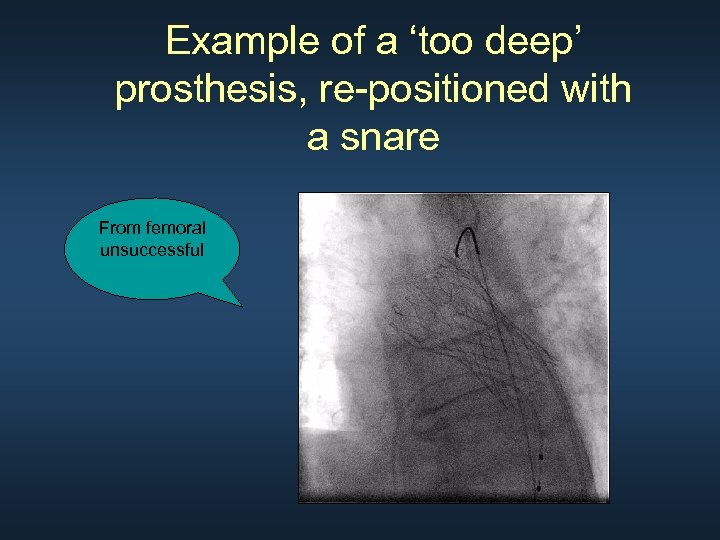 Example of a ‘too deep’ prosthesis, re-positioned with a snare From femoral unsuccessful 