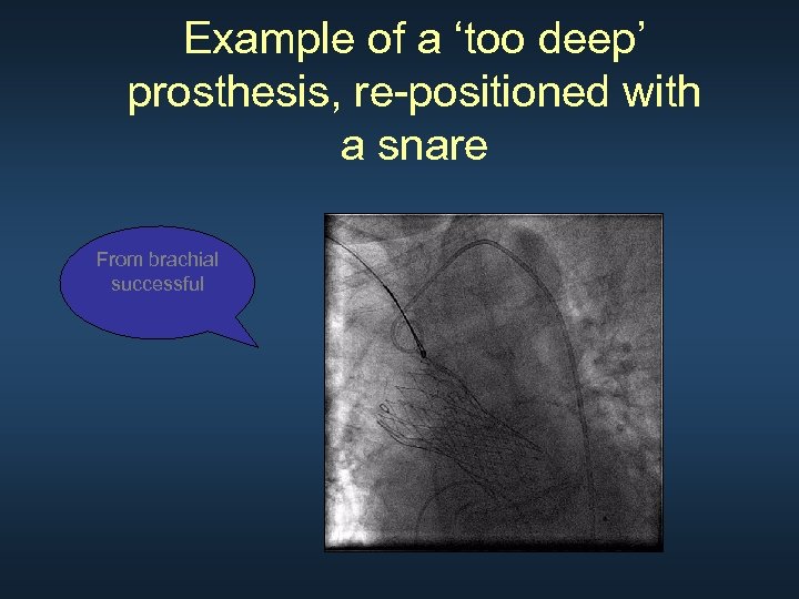 Example of a ‘too deep’ prosthesis, re-positioned with a snare From brachial successful 