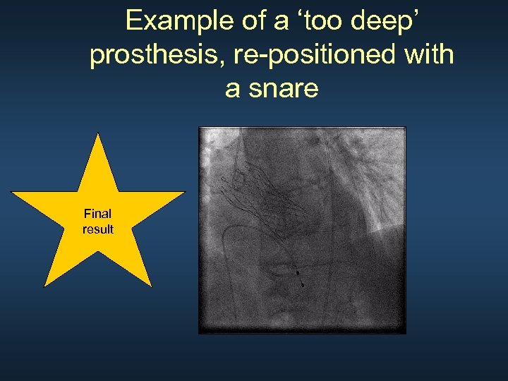 Example of a ‘too deep’ prosthesis, re-positioned with a snare Final result 