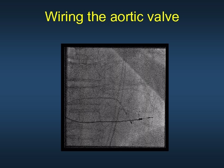 Wiring the aortic valve 