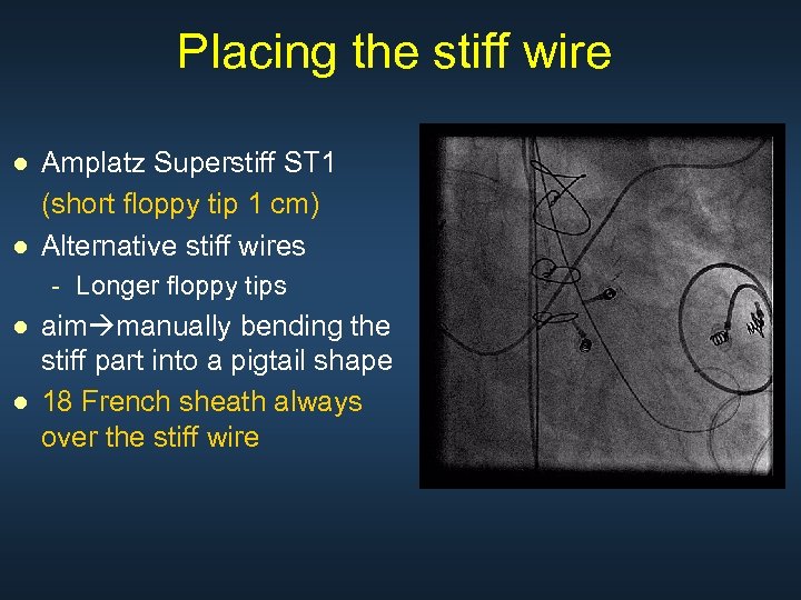 Placing the stiff wire ● Amplatz Superstiff ST 1 (short floppy tip 1 cm)