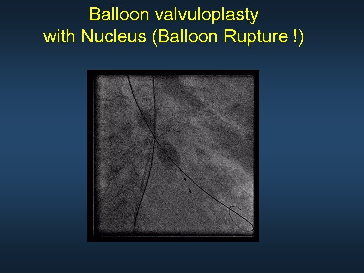 Balloon valvuloplasty with Nucleus (Balloon Rupture !) 