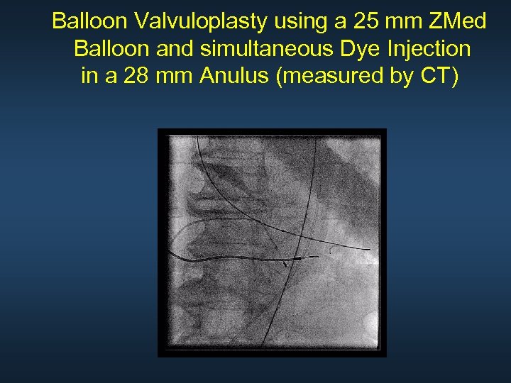 Balloon Valvuloplasty using a 25 mm ZMed Balloon and simultaneous Dye Injection in a