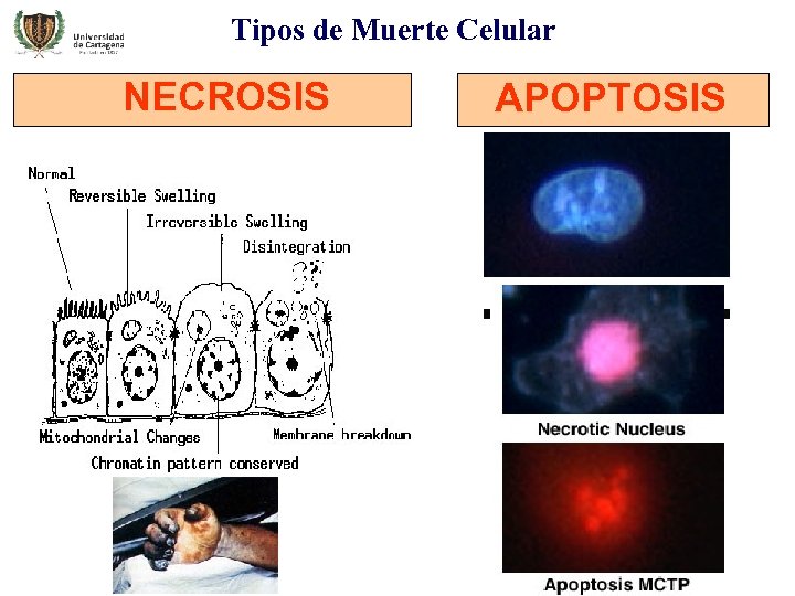 Tipos de Muerte Celular NECROSIS APOPTOSIS 